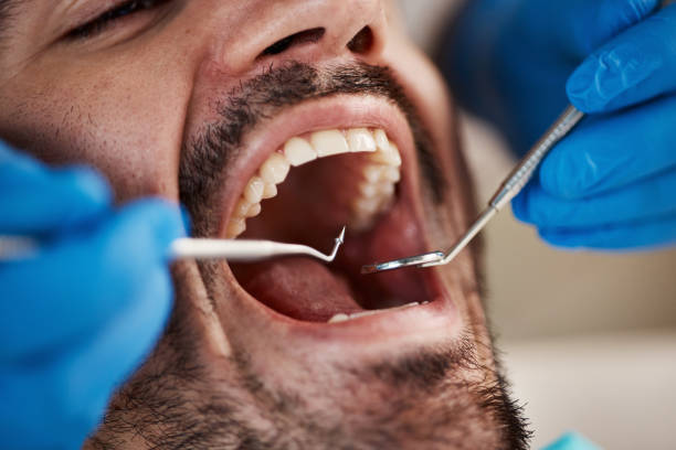 Best Emergency Wisdom Tooth Extraction in Flanders, NJ